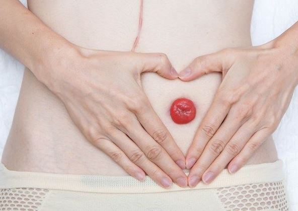 Stoma